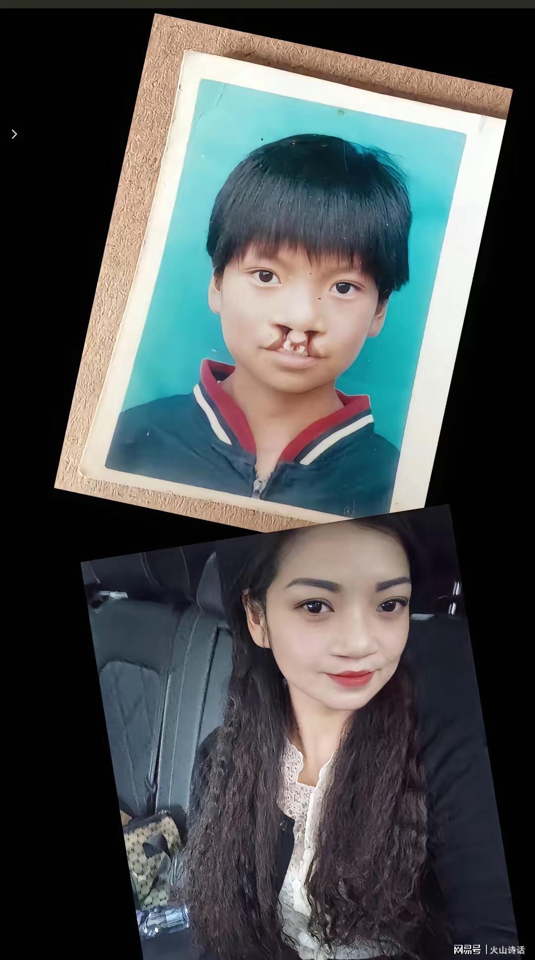 NFL-震惊!为声援李亚鹏,一漂亮女孩坦然展示自己唇腭裂手术前后照片